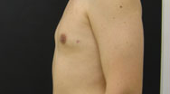 Gynecomastia