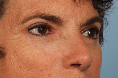 Blepharoplasty