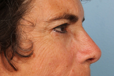 Blepharoplasty