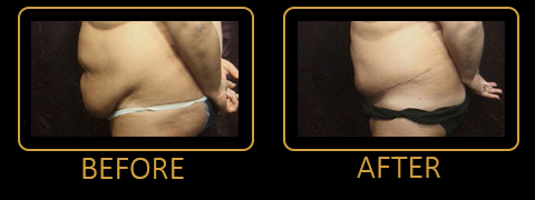 Tummy Tuck and Bilateral Liposuction to Hips - Case #44473 - The